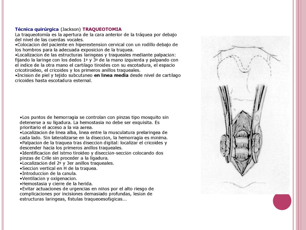 Técnica quirúrgica (Jackson) TRAQUEOTOMIA La traqueotomía es la apertura de la cara anterior de la tráquea por debajo del nivel de las cuerdas vocales.