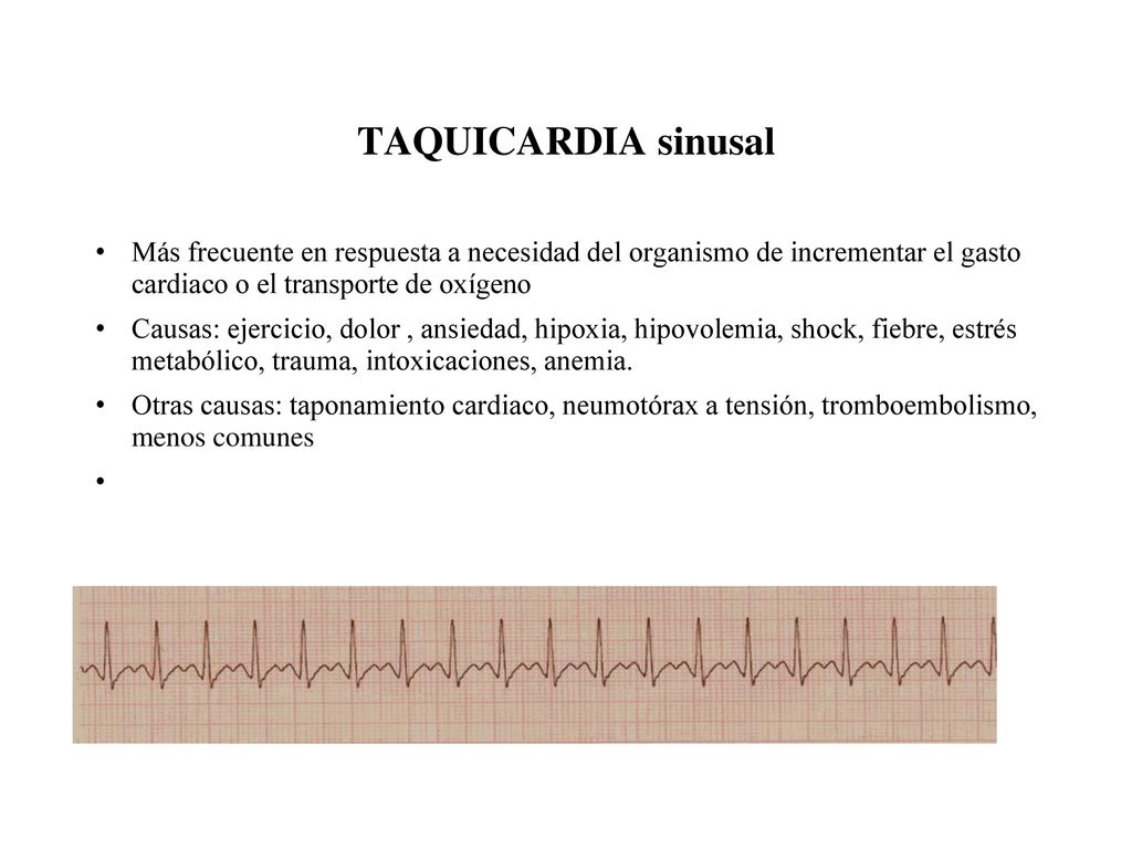TAQUICARDIA sinusal Más frecuente en respuesta a necesidad del organismo de incrementar el gasto cardiaco o el transporte de oxígeno.