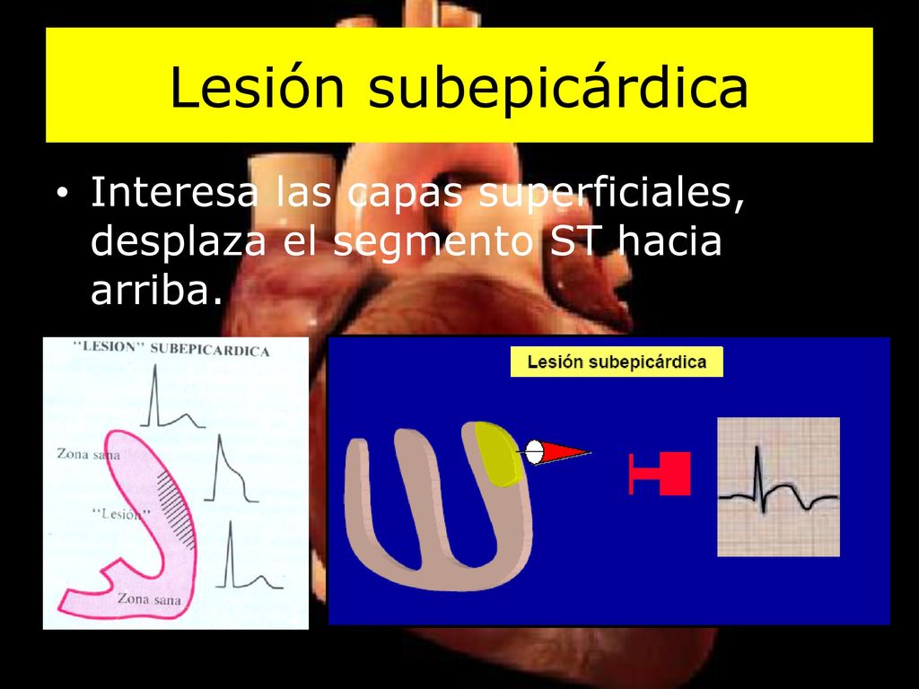 Lesión subepicárdica Interesa las capas superficiales, desplaza el segmento ST hacia arriba.
