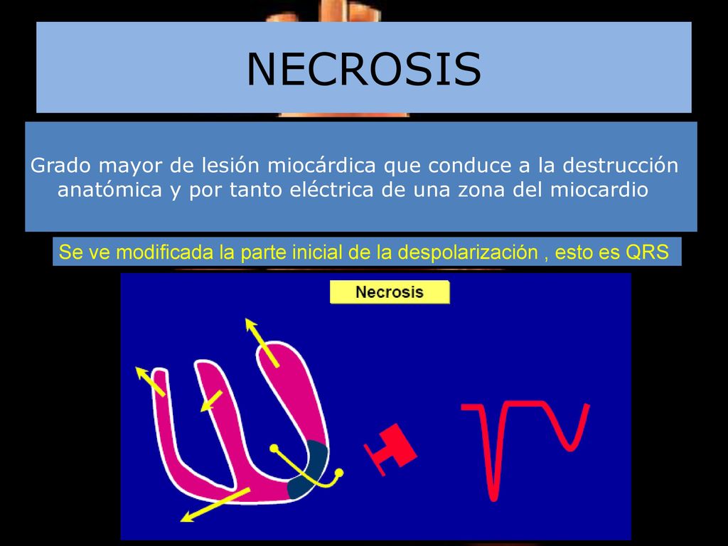 NECROSIS Grado mayor de lesión miocárdica que conduce a la destrucción anatómica y por tanto eléctrica de una zona del miocardio.