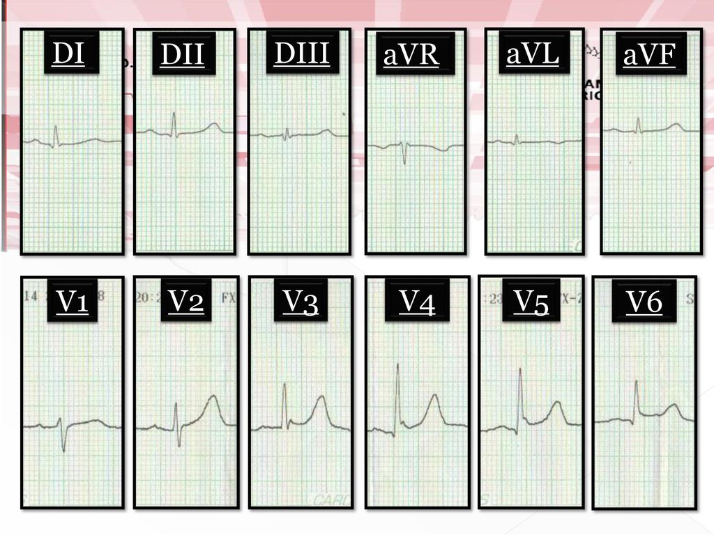 DI DII DIII aVR aVL aVF V1 V2 V3 V4 V5 V6