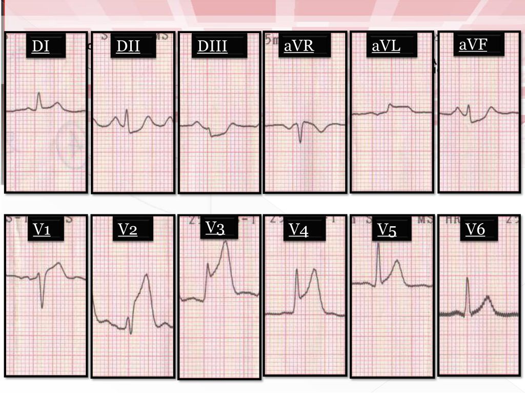 DI DII DIII aVR aVL aVF V1 V2 V3 V4 V5 V6