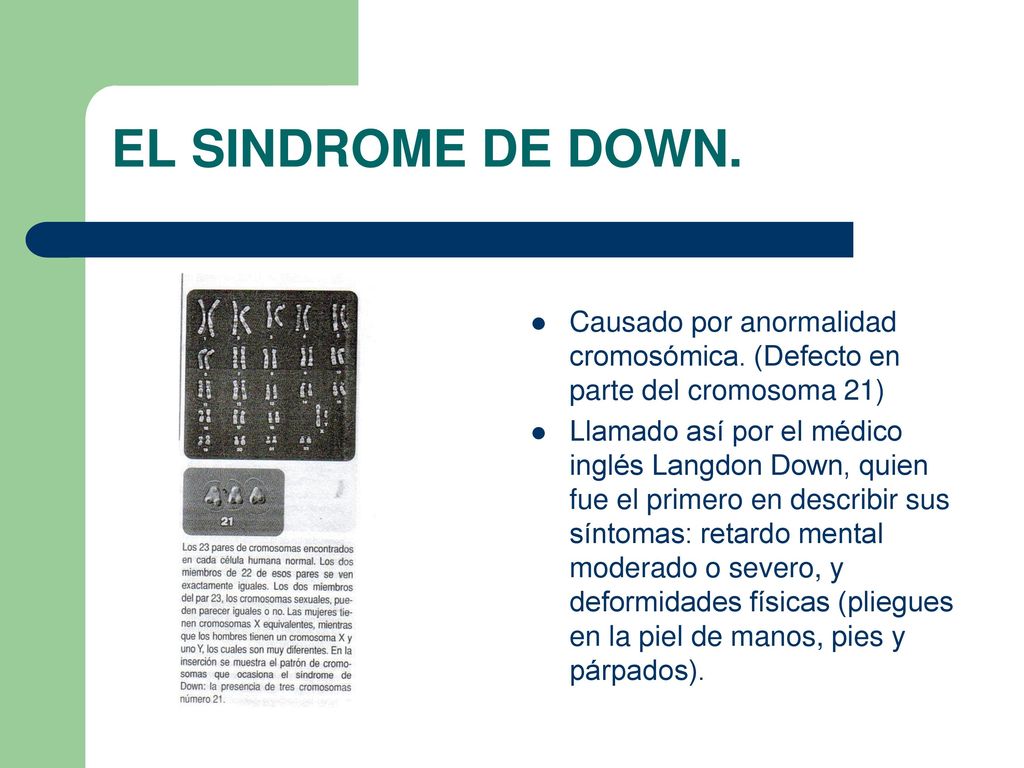 EL SINDROME DE DOWN. Causado por anormalidad cromosómica. (Defecto en parte del cromosoma 21)