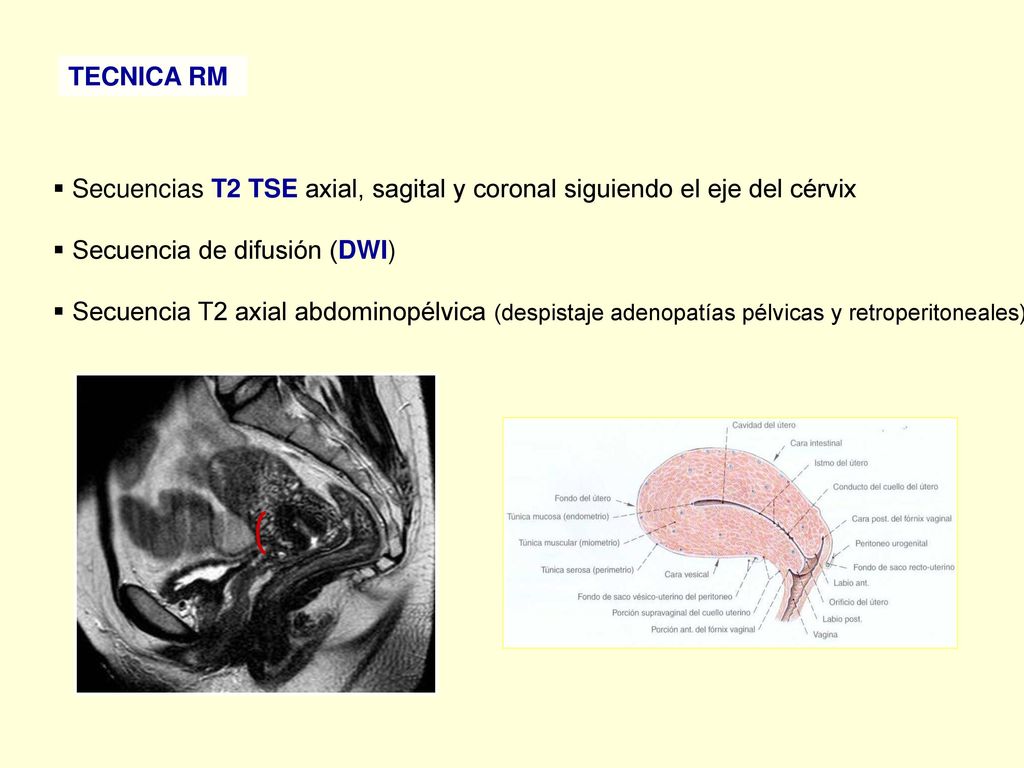 TECNICA RM Secuencias T2 TSE axial, sagital y coronal siguiendo el eje del cérvix. Secuencia de difusión (DWI)
