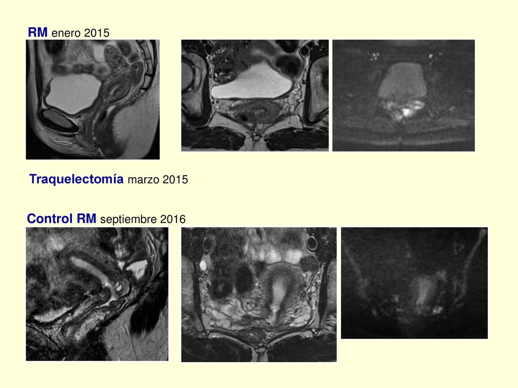 RM enero 2015 Traquelectomía marzo 2015 Control RM septiembre 2016