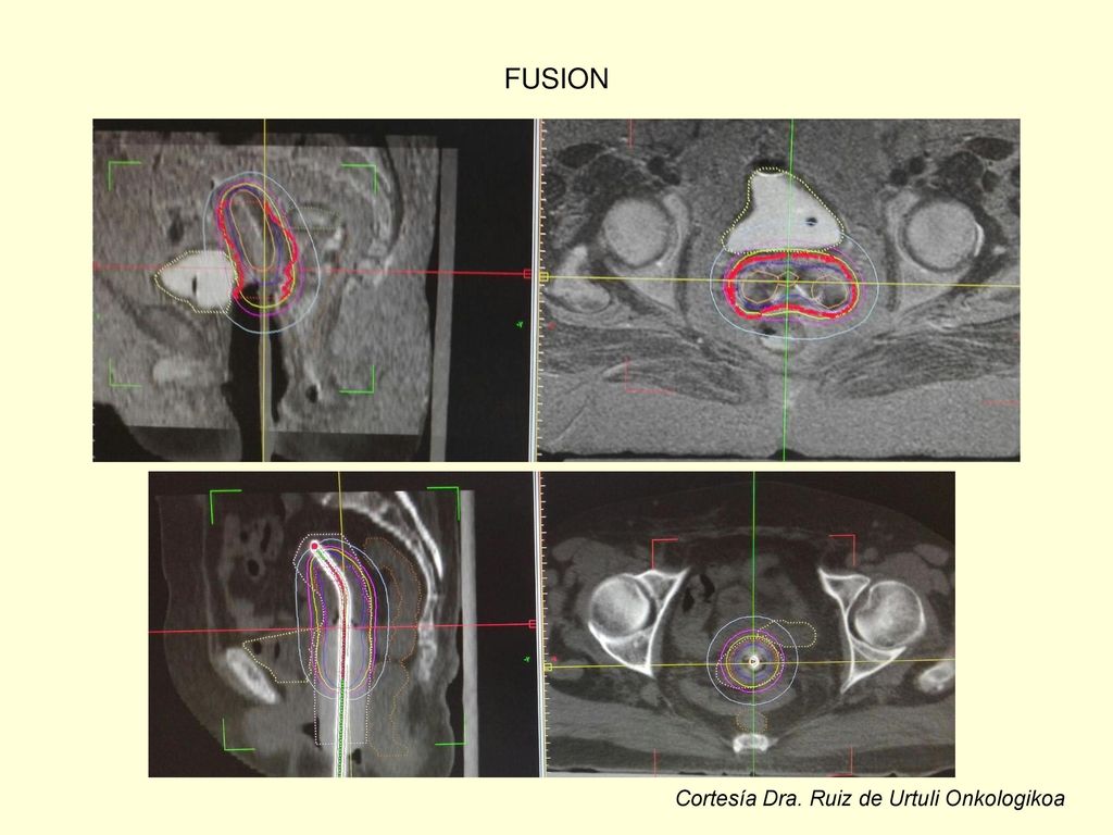 FUSION Cortesía Dra. Ruiz de Urtuli Onkologikoa