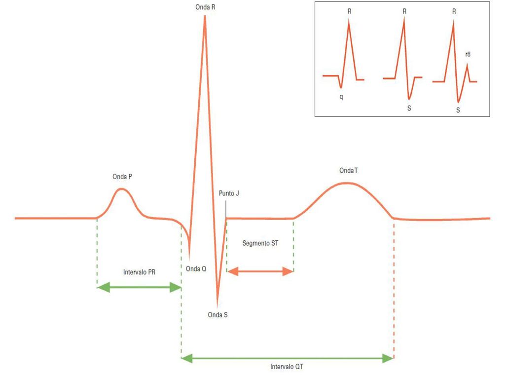 Figura 27-6 ECG normal y ejemplos de variantes de nomenclatura de variantes del complejo QRS (recuadro).