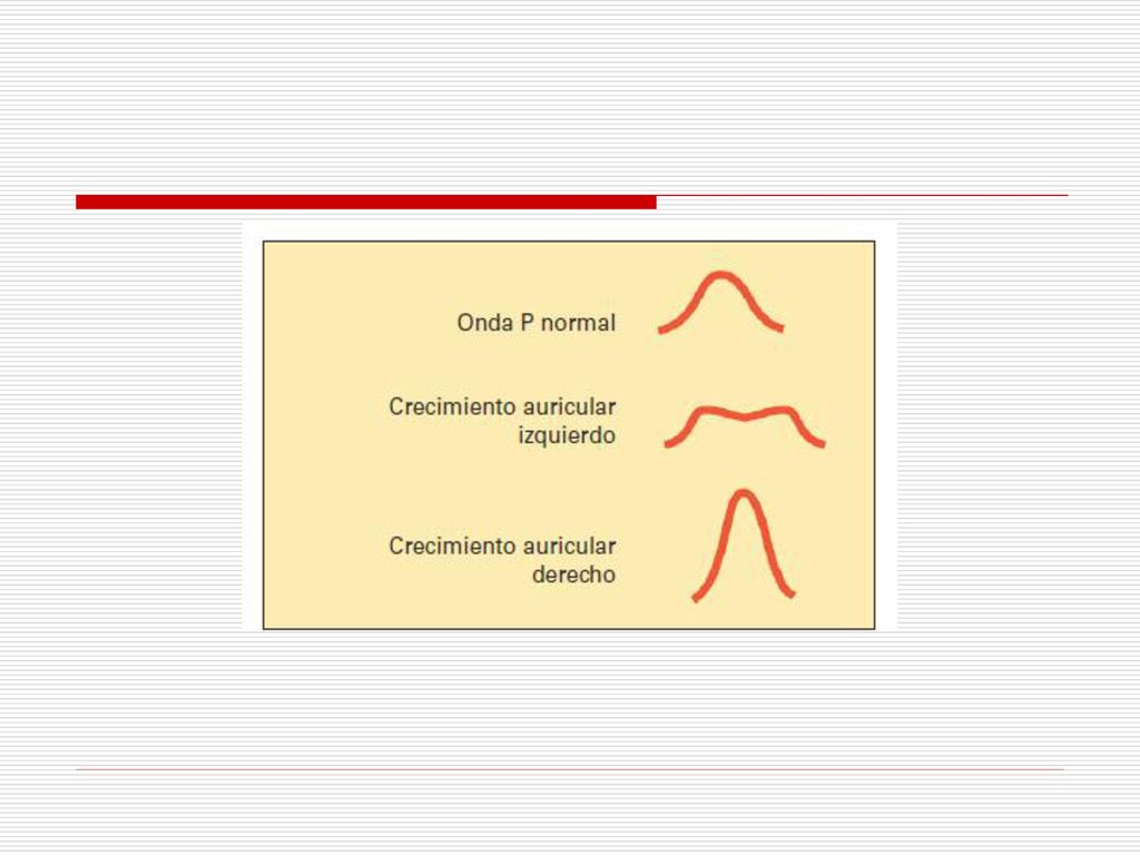 Figura Onda P normal y patrones electrocardiográficos de crecimiento auricular.