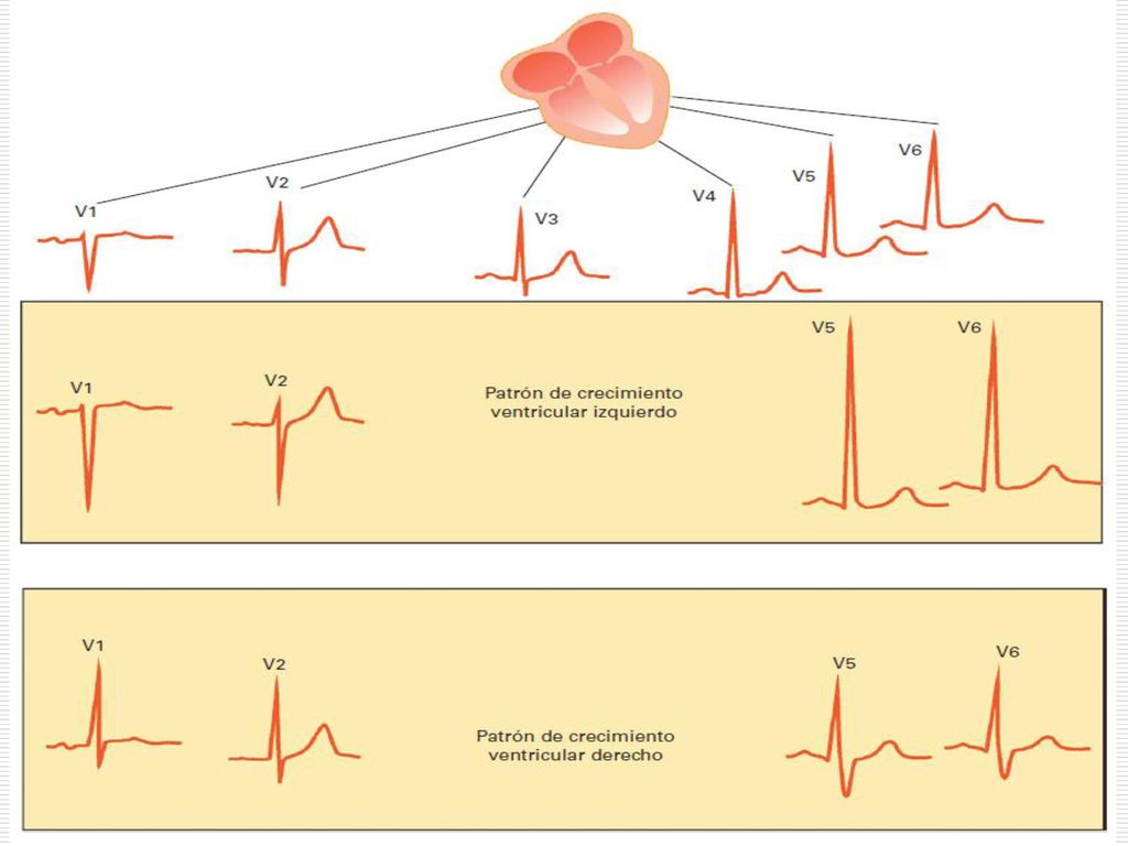 Figura Derivaciones normales en el plano horizontal (parte superior de la figura) y patrones electrocardiográficos de crecimiento ventricula