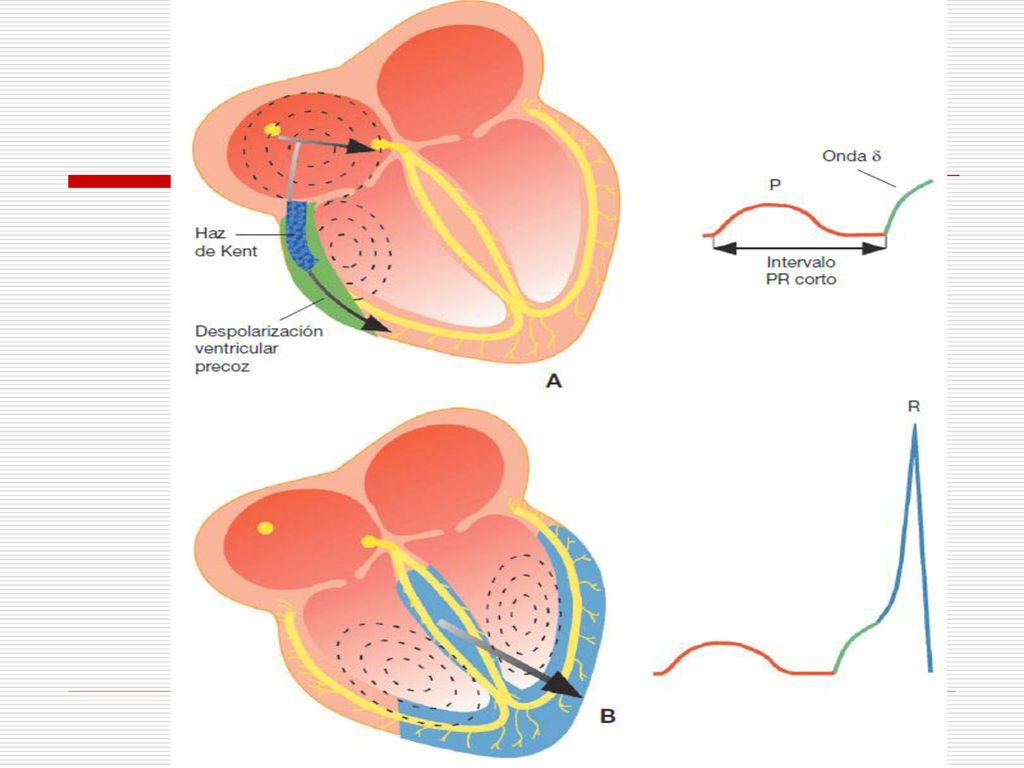 Figura Conducción acelerada o preexcitación: secuencia de la despolarización ventricular. A) Una parte de la corriente eléctrica generada en la aurícula pasa directamente al ventrículo sin detenerse en el nódulo auriculoventricular (acortamiento del intervalo PR) y activa precozmente una región ventricular, difundiendo a través del miocardio contráctil (onda δ). B) El resto del ventrículo se despolariza siguiendo la vía normal, completando la onda R.