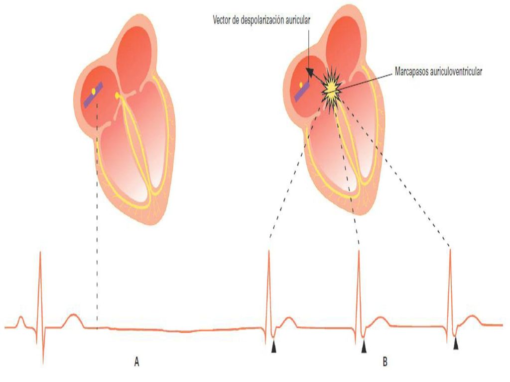 Figura Pausa sinusal (A) y ritmo de escape de la unión auriculoventricular (B). Las puntas de flecha señalan ondas P negativas retrógradas