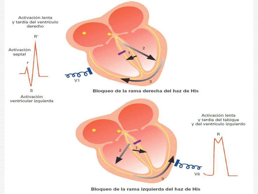 Figura Bloqueo de una rama del haz de His (los números indican la secuencia de la despolarización ventricular).
