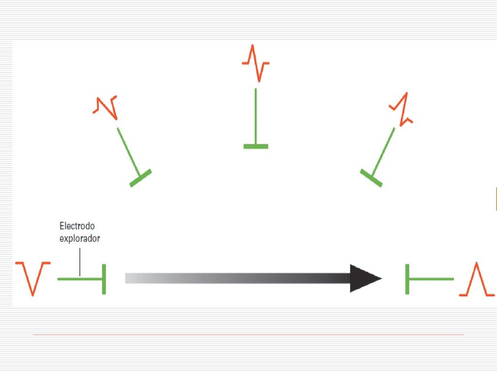 Figura 27-2 Deflexiones que inscribe el electrocardiógrafo según la relación existente entre la ubicación del electrodo explorador y la dirección del vector generado por los flujos de corriente (flecha).