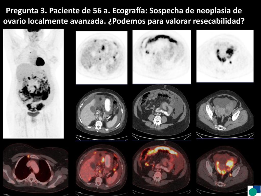 Pregunta 3. Paciente de 56 a. Ecografía: Sospecha de neoplasia de ovario localmente avanzada.