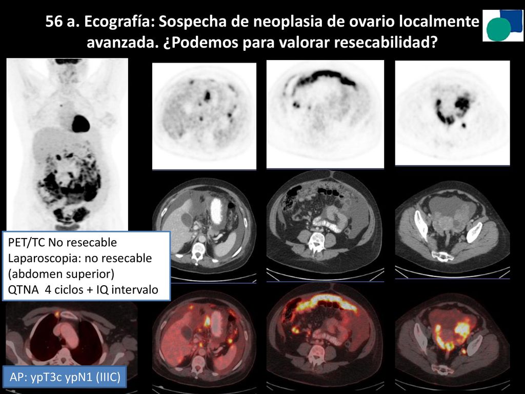56 a. Ecografía: Sospecha de neoplasia de ovario localmente avanzada