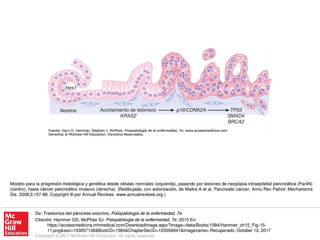 Modelo para la progresión histológica y genética desde células normales (izquierda), pasando por lesiones de neoplasia intraepitelial pancreática (PanIN) (centro), hasta cáncer pancreático invasivo (derecha). (Redibujada, con autorización, de Maitra A et al. Pancreatic cancer. Annu Rev Pathol: Mechanisms Dis. 2008;3: Copyright © por Annual Reviews.