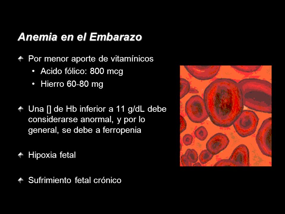 Anemia en el Embarazo Por menor aporte de vitamínicos