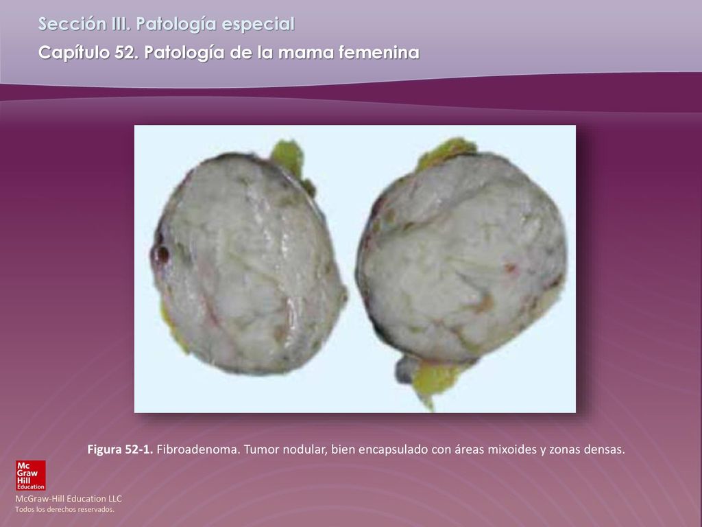 Figura Fibroadenoma. Tumor nodular, bien encapsulado con áreas mixoides y zonas densas.