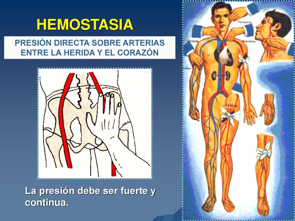 PRESIÓN DIRECTA SOBRE ARTERIAS ENTRE LA HERIDA Y EL CORAZÓN