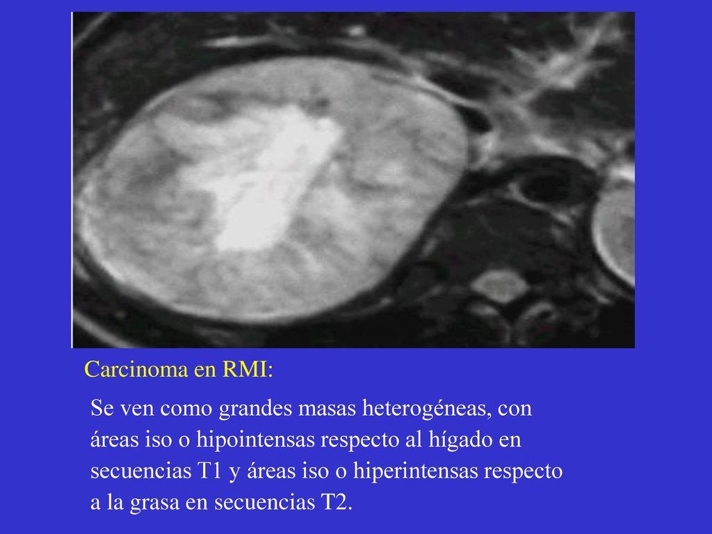 Carcinoma en RMI: Se ven como grandes masas heterogéneas, con. áreas iso o hipointensas respecto al hígado en.