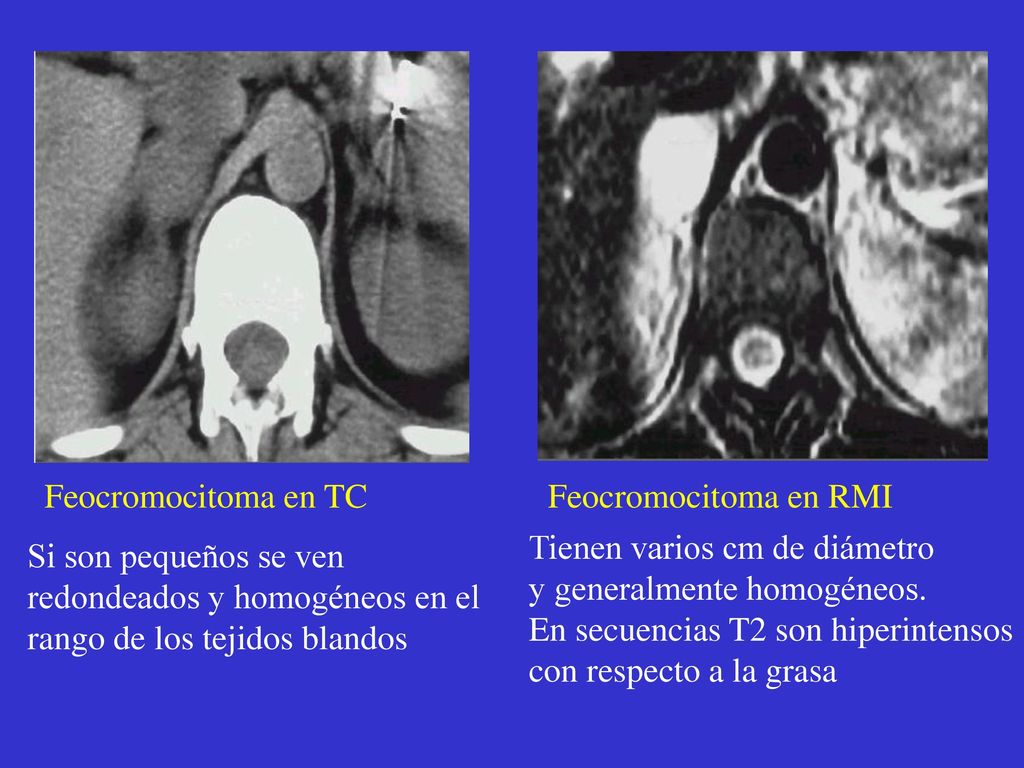 Feocromocitoma en TC Feocromocitoma en RMI. Tienen varios cm de diámetro. y generalmente homogéneos.
