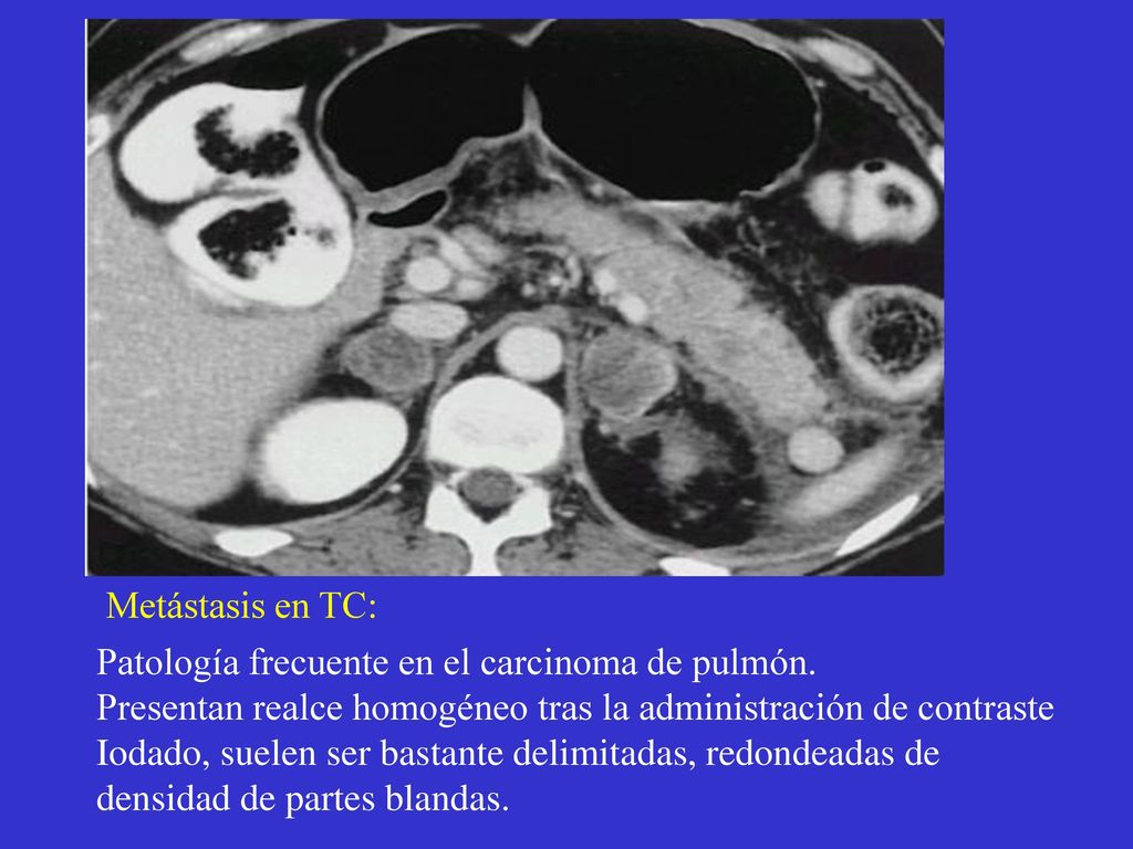 Metástasis en TC: Patología frecuente en el carcinoma de pulmón. Presentan realce homogéneo tras la administración de contraste.