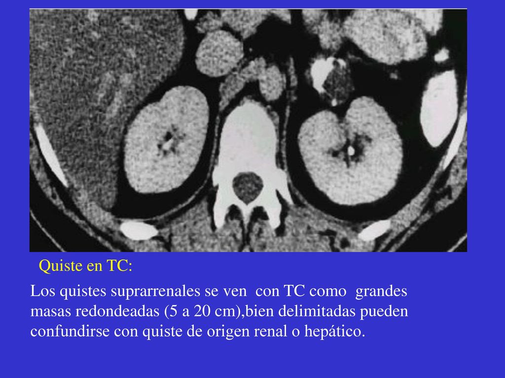 Quiste en TC: Los quistes suprarrenales se ven con TC como grandes.