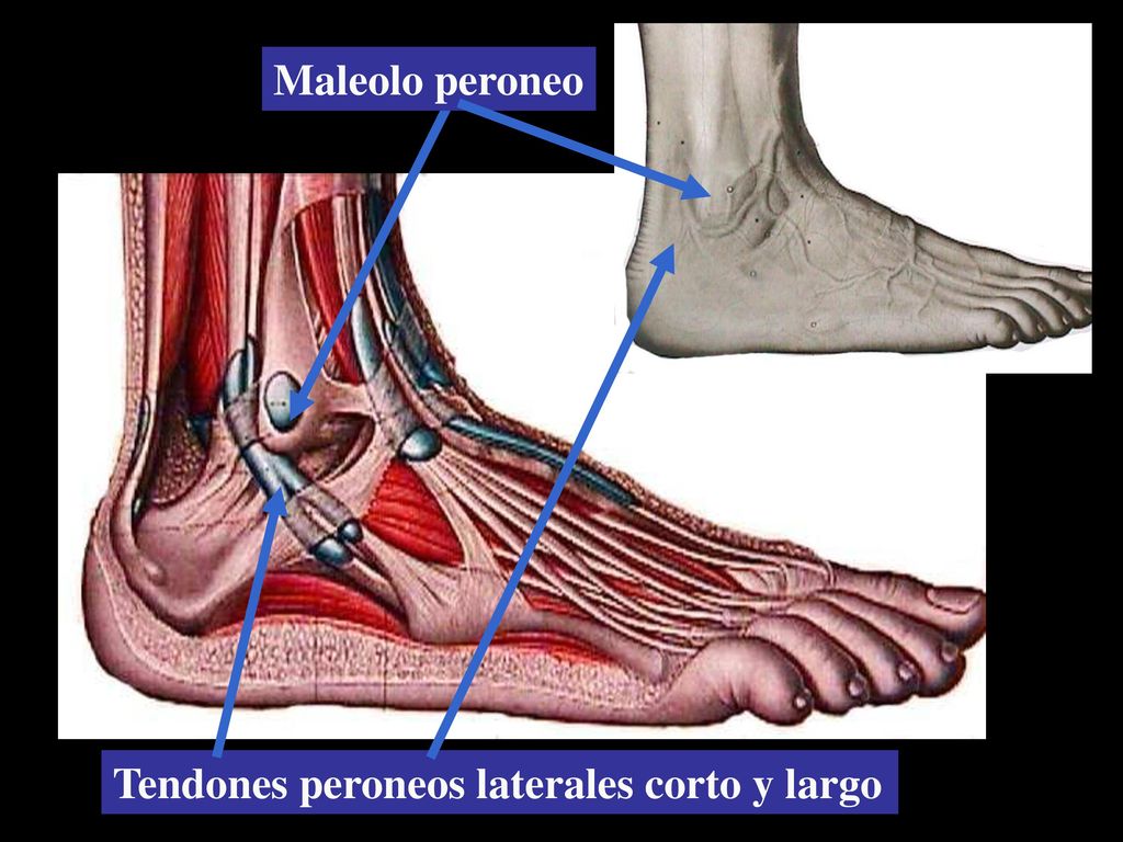 Maleolo peroneo Tendones peroneos laterales corto y largo