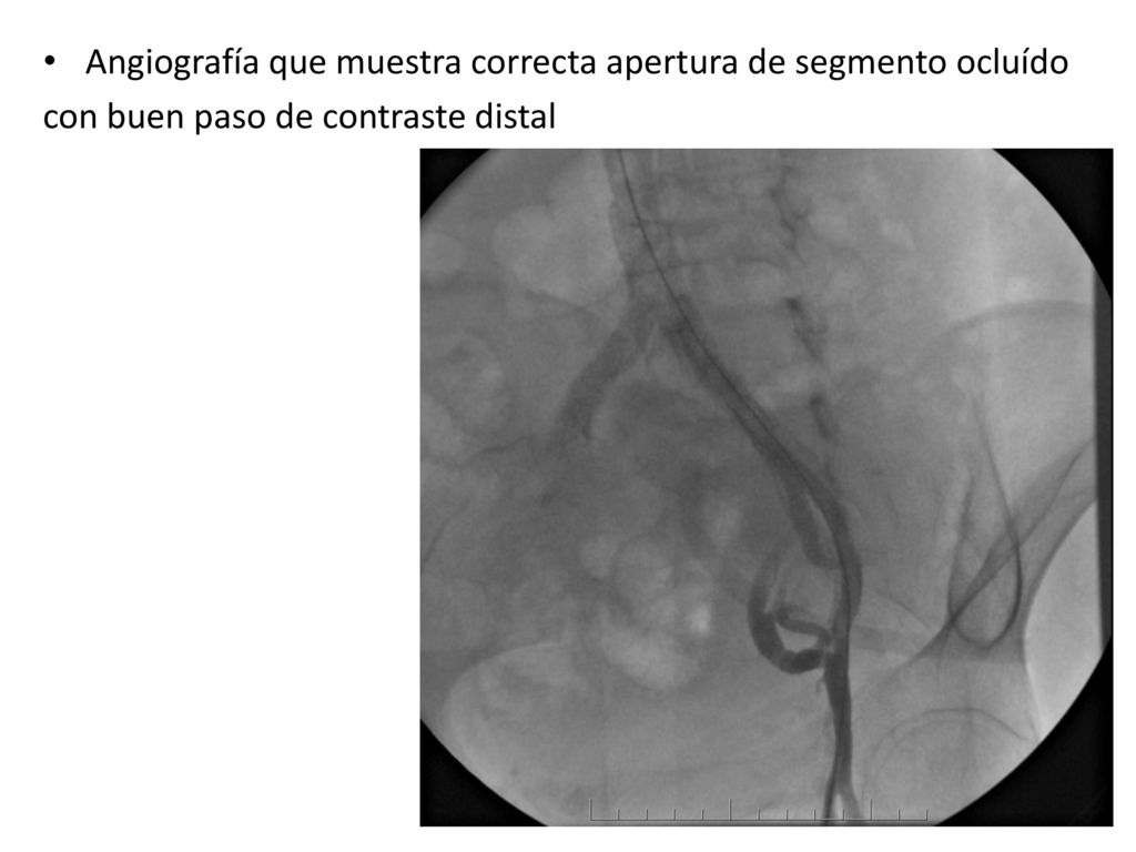 Angiografía que muestra correcta apertura de segmento ocluído
