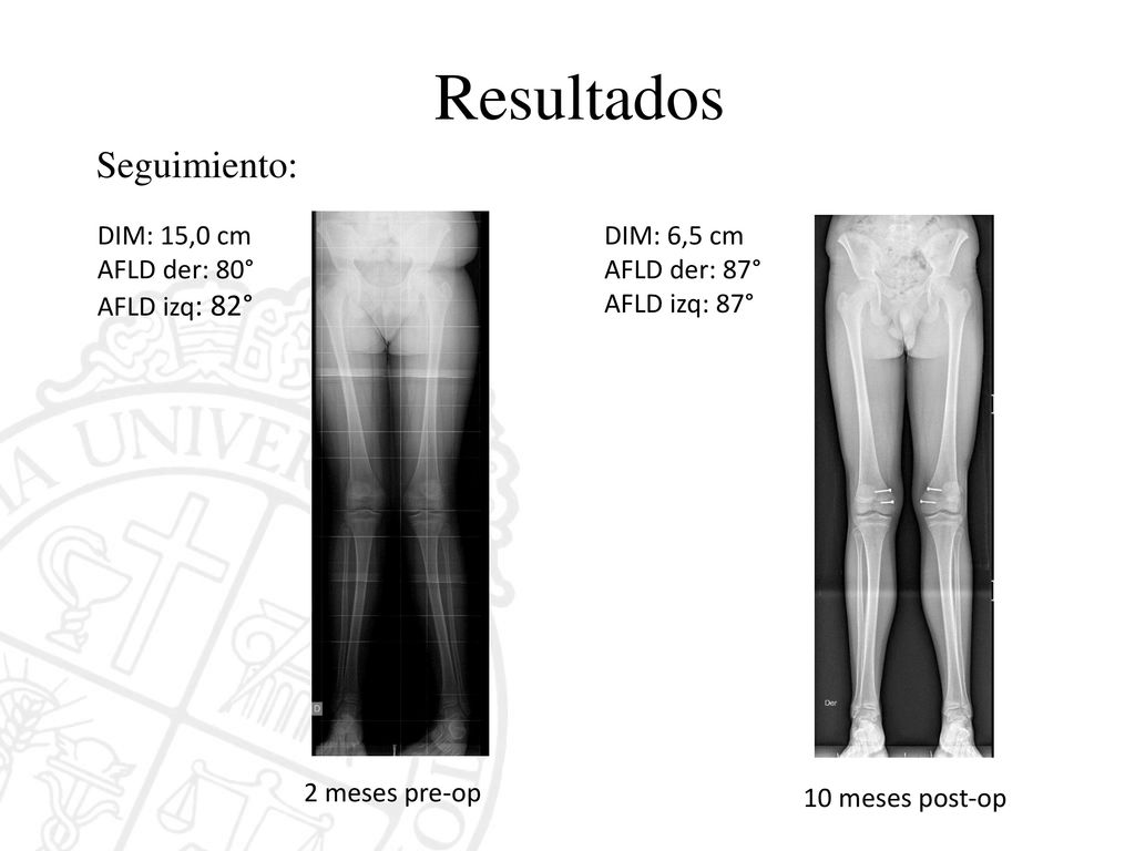 Resultados Seguimiento: DIM: 15,0 cm AFLD der: 80° AFLD izq: 82°