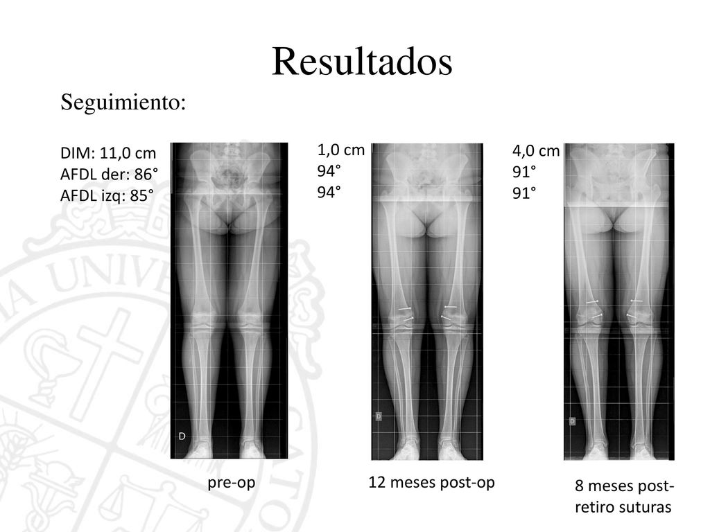 Resultados Seguimiento: DIM: 11,0 cm AFDL der: 86° AFDL izq: 85°