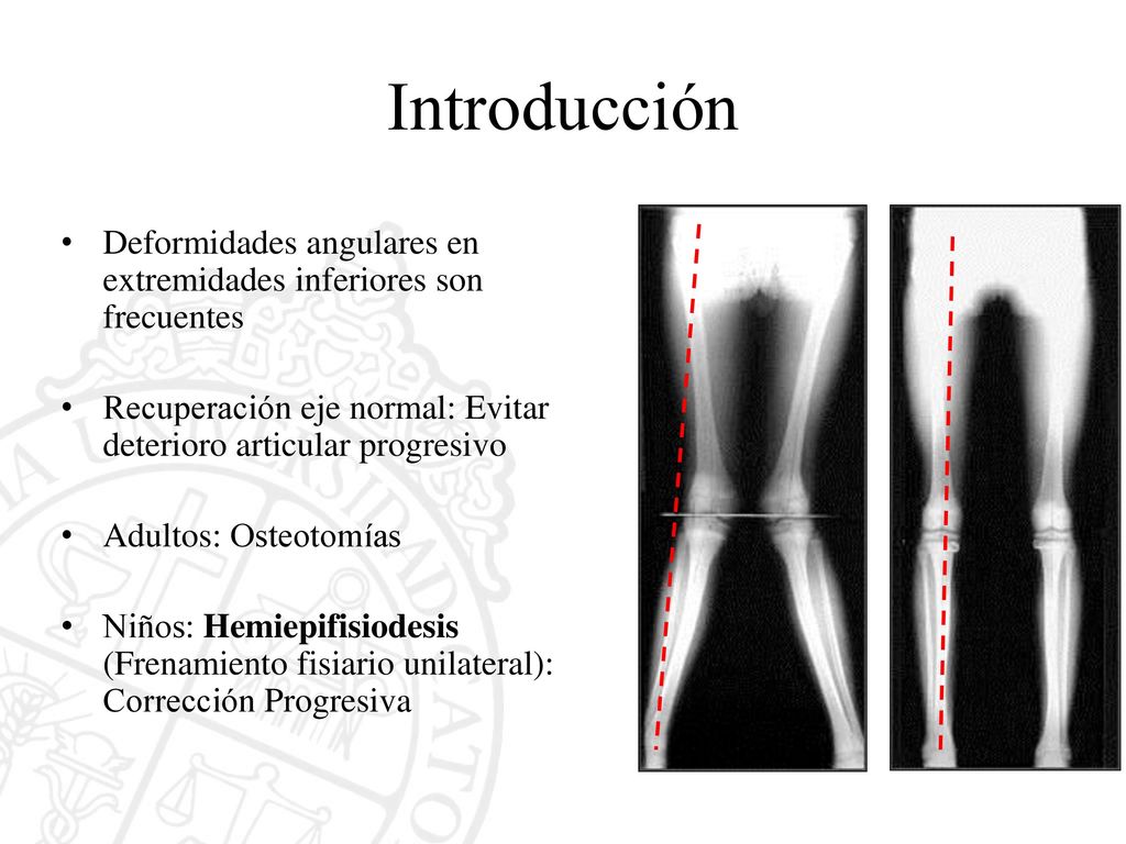 Introducción Deformidades angulares en extremidades inferiores son frecuentes. Recuperación eje normal: Evitar deterioro articular progresivo.