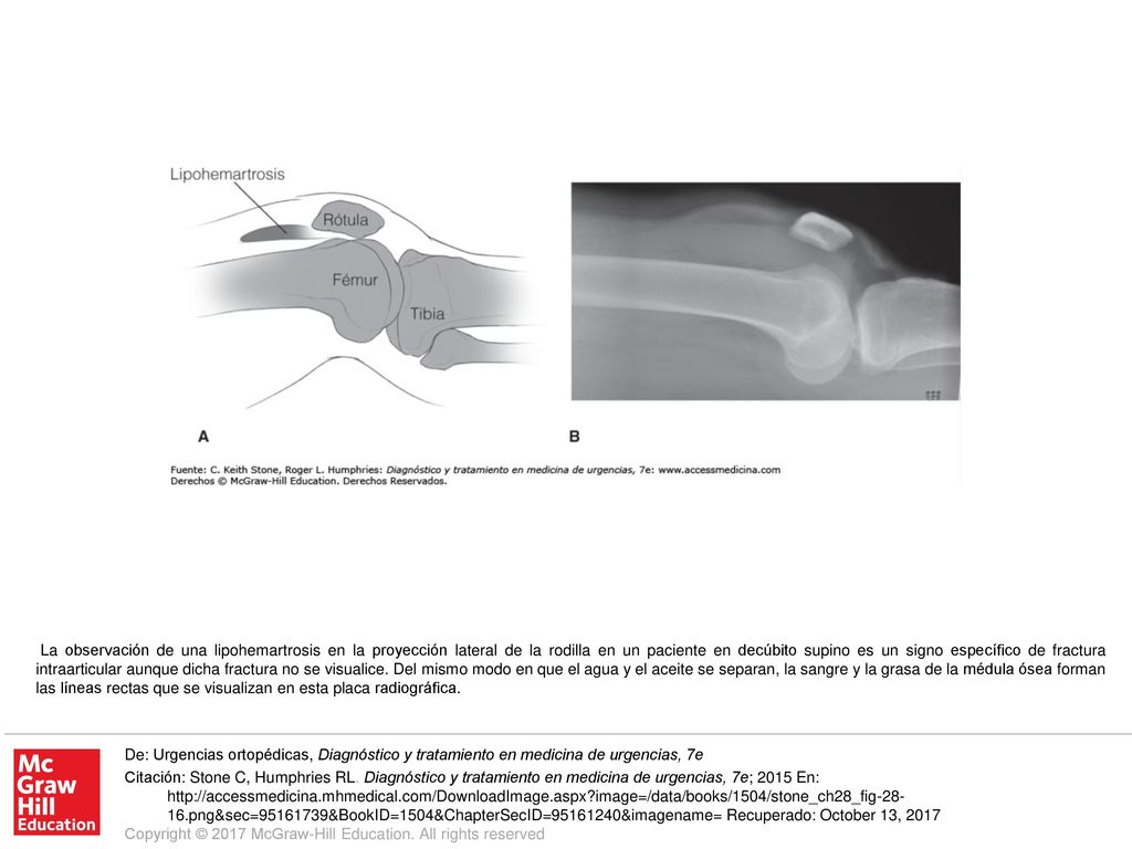 La observación de una lipohemartrosis en la proyección lateral de la rodilla en un paciente en decúbito supino es un signo específico de fractura intraarticular aunque dicha fractura no se visualice. Del mismo modo en que el agua y el aceite se separan, la sangre y la grasa de la médula ósea forman las líneas rectas que se visualizan en esta placa radiográfica.