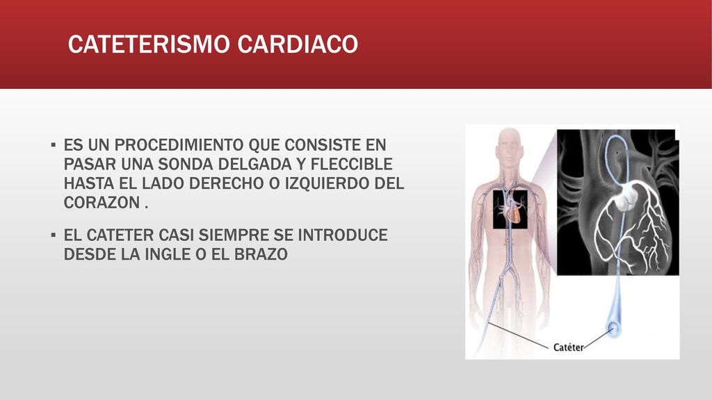 CATETERISMO CARDIACO ES UN PROCEDIMIENTO QUE CONSISTE EN PASAR UNA SONDA DELGADA Y FLECCIBLE HASTA EL LADO DERECHO O IZQUIERDO DEL CORAZON .