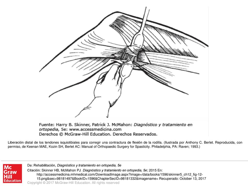 Liberación distal de los tendones isquiotibiales para corregir una contractura de flexión de la rodilla. (Ilustrada por Anthony C. Berlet. Reproducida, con permiso, de Keenan MAE, Kozin SH, Berlet AC: Manual of Orthopaedic Surgery for Spasticity. Philadelphia, PA: Raven; 1993.)