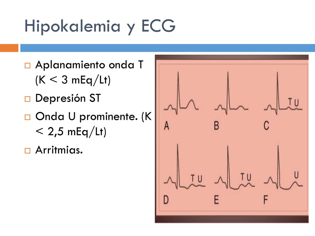 Hipokalemia y ECG Aplanamiento onda T (K < 3 mEq/Lt) Depresión ST