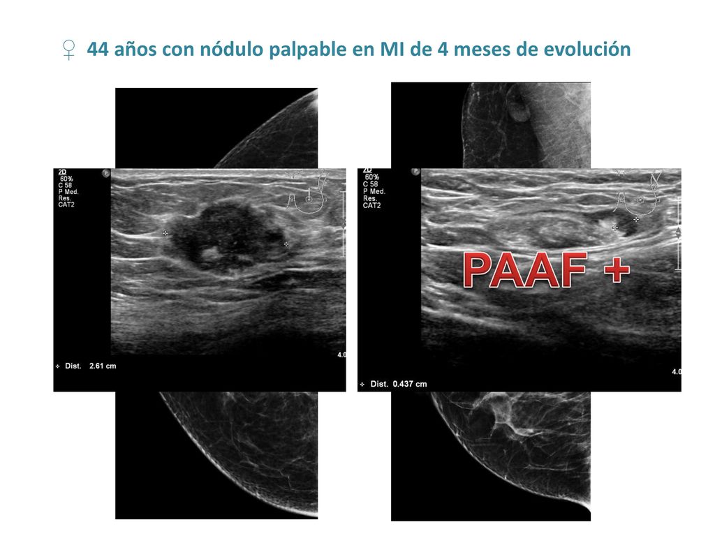 PAAF + ♀ 44 años con nódulo palpable en MI de 4 meses de evolución