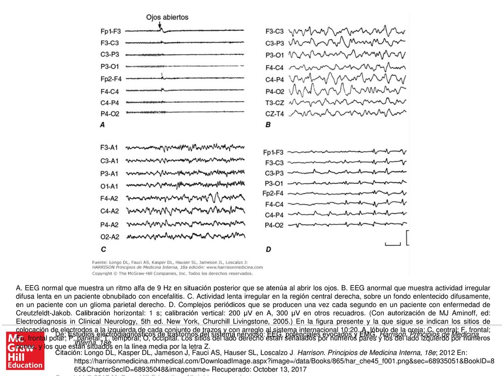 A. EEG normal que muestra un ritmo alfa de 9 Hz en situación posterior que se atenúa al abrir los ojos. B. EEG anormal que muestra actividad irregular difusa lenta en un paciente obnubilado con encefalitis. C. Actividad lenta irregular en la región central derecha, sobre un fondo enlentecido difusamente, en un paciente con un glioma parietal derecho. D. Complejos periódicos que se producen una vez cada segundo en un paciente con enfermedad de Creutzfeldt-Jakob. Calibración horizontal: 1 s; calibración vertical: 200 μV en A, 300 μV en otros recuadros. (Con autorización de MJ Aminoff, ed: Electrodiagnosis in Clinical Neurology, 5th ed. New York, Churchill Livingstone, 2005.) En la figura presente y la que sigue se indican los sitios de colocación de electrodos a la izquierda de cada conjunto de trazos y con arreglo al sistema internacional 10:20. A, lóbulo de la oreja; C, central; F, frontal; Fp, frontal polar; P, parietal; T, temporal; O, occipital. Los sitios del lado derecho están señalados por números pares y los del lado izquierdo por números nones, y los que están situados en la línea media por la letra Z.