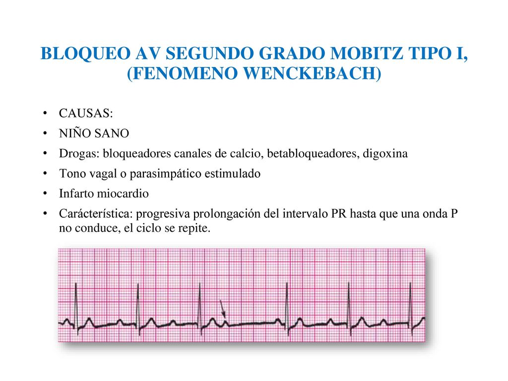 BLOQUEO AV SEGUNDO GRADO MOBITZ TIPO I, (FENOMENO WENCKEBACH)