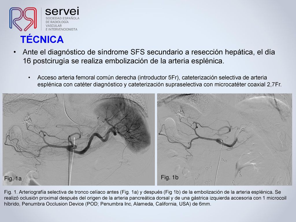 TÉCNICA Ante el diagnóstico de síndrome SFS secundario a resección hepática, el día 16 postcirugía se realiza embolización de la arteria esplénica.