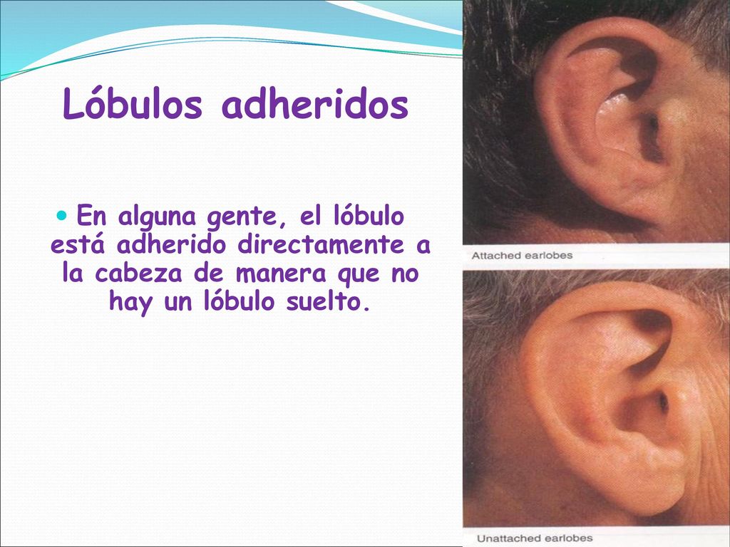 Lóbulos adheridos En alguna gente, el lóbulo está adherido directamente a la cabeza de manera que no hay un lóbulo suelto.