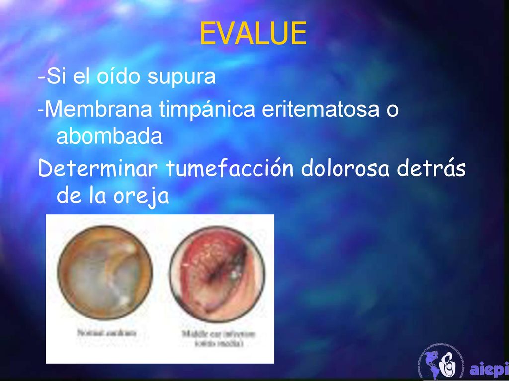EVALUE -Si el oído supura -Membrana timpánica eritematosa o abombada