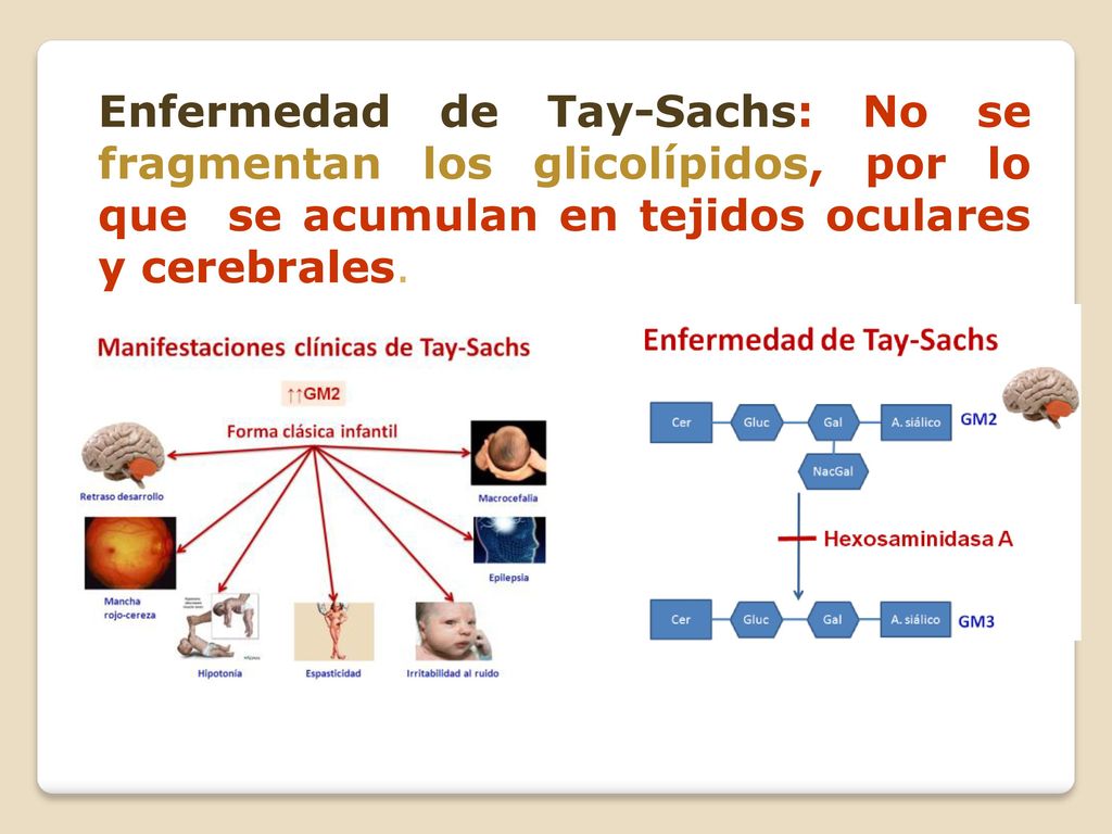 Enfermedad de Tay-Sachs: No se fragmentan los glicolípidos, por lo que se acumulan en tejidos oculares y cerebrales.