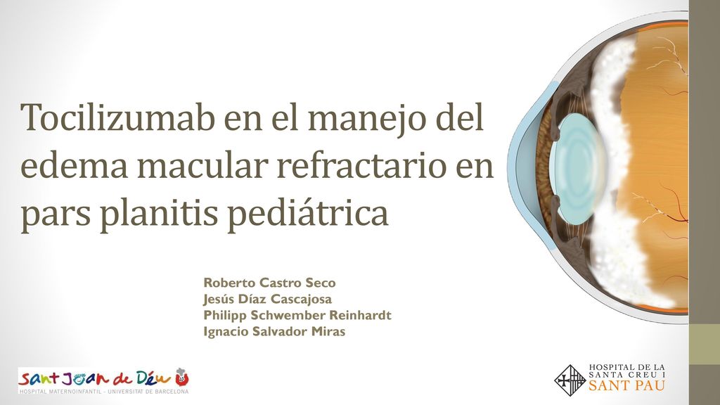Tocilizumab en el manejo del edema macular refractario en pars planitis pediátrica