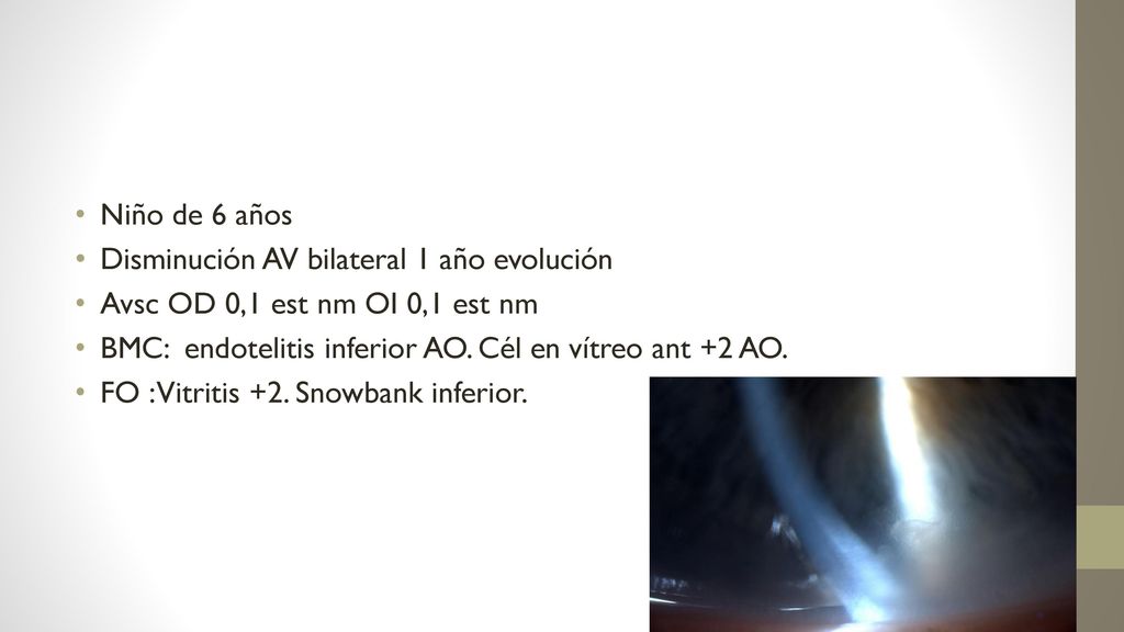Niño de 6 años Disminución AV bilateral 1 año evolución. Avsc OD 0,1 est nm OI 0,1 est nm. BMC: endotelitis inferior AO. Cél en vítreo ant +2 AO.