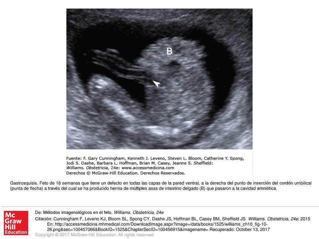 Gastrosquisis. Feto de 18 semanas que tiene un defecto en todas las capas de la pared ventral, a la derecha del punto de inserción del cordón umbilical (punta de flecha) a través del cual se ha producido hernia de múltiples asas de intestino delgado (B) que pasaron a la cavidad amniótica.