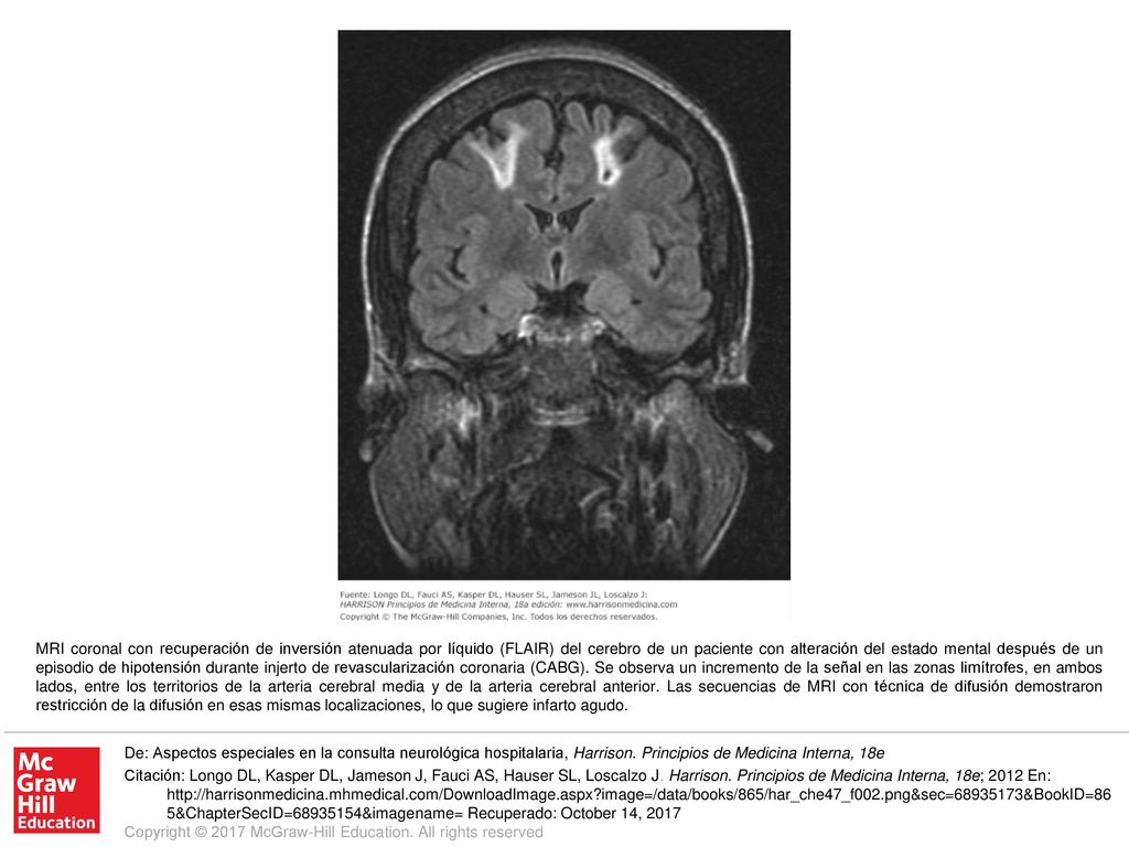 MRI coronal con recuperación de inversión atenuada por líquido (FLAIR) del cerebro de un paciente con alteración del estado mental después de un episodio de hipotensión durante injerto de revascularización coronaria (CABG). Se observa un incremento de la señal en las zonas limítrofes, en ambos lados, entre los territorios de la arteria cerebral media y de la arteria cerebral anterior. Las secuencias de MRI con técnica de difusión demostraron restricción de la difusión en esas mismas localizaciones, lo que sugiere infarto agudo.
