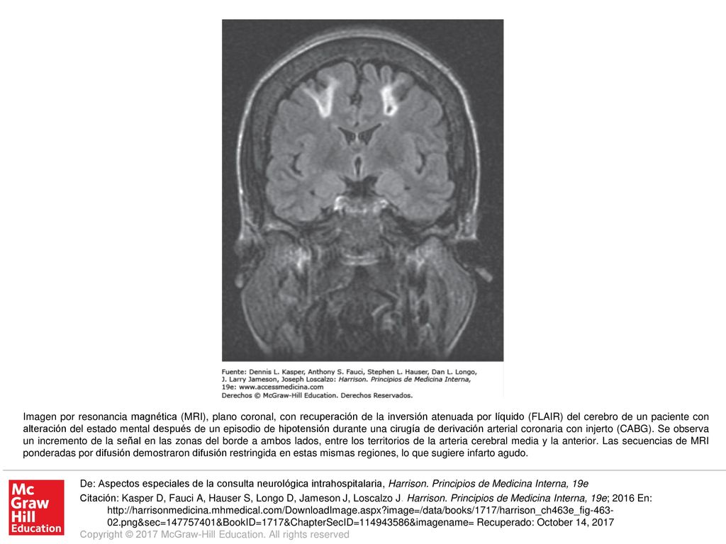 Imagen por resonancia magnética (MRI), plano coronal, con recuperación de la inversión atenuada por líquido (FLAIR) del cerebro de un paciente con alteración del estado mental después de un episodio de hipotensión durante una cirugía de derivación arterial coronaria con injerto (CABG). Se observa un incremento de la señal en las zonas del borde a ambos lados, entre los territorios de la arteria cerebral media y la anterior. Las secuencias de MRI ponderadas por difusión demostraron difusión restringida en estas mismas regiones, lo que sugiere infarto agudo.