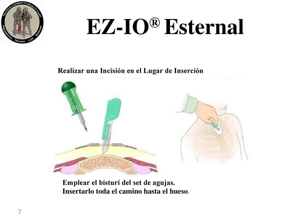 EZ-IO® Esternal Realizar una Incisión en el Lugar de Inserción