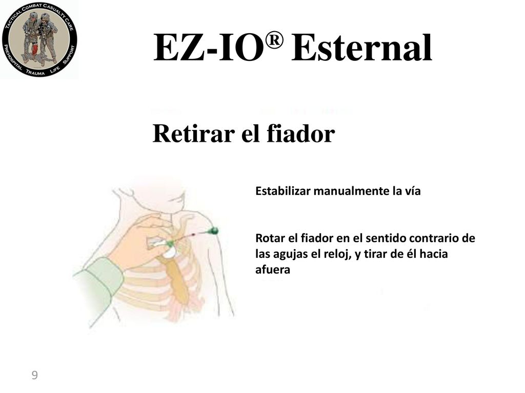 EZ-IO® Esternal Retirar el fiador Estabilizar manualmente la vía